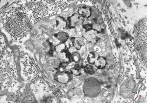 M,40y. | granular cell tumor M,40y. | granular cell tumor